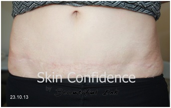 Surgical scar on abdomen